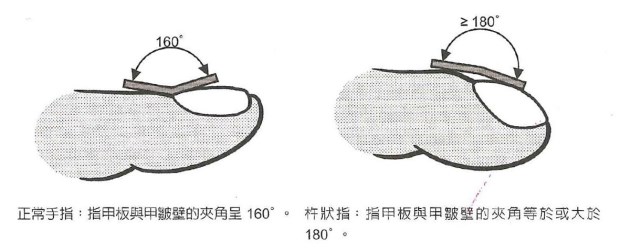 怎樣看出心臟有問題 從手指、舌頭眼神測試