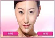美白針真的有效嗎？美白針的危害有哪些？