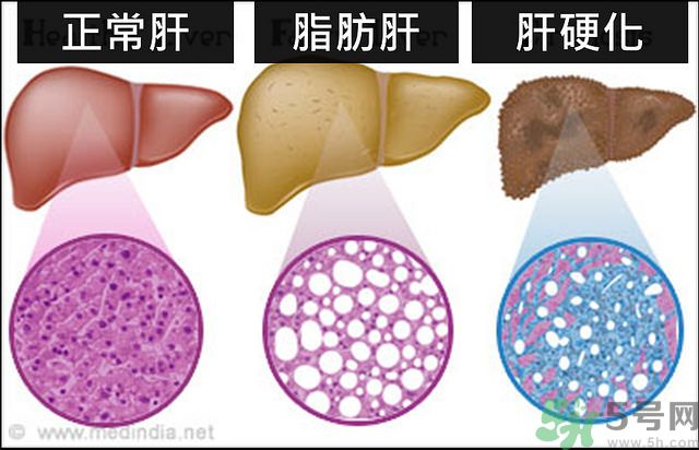 得了脂肪肝該怎么治？脂肪肝對人體危害有多大？