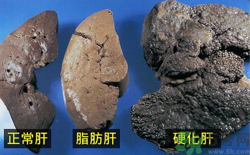 得了脂肪肝該怎么治？脂肪肝對人體危害有多大？