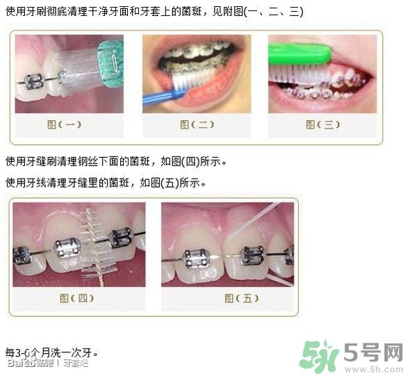 18歲還能戴牙套嗎？戴牙套真的能瘦臉改變臉型嗎？
