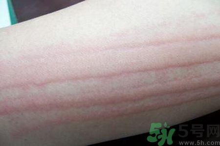 蕁麻疹會不會傳染？蕁麻疹怎么治才能好？