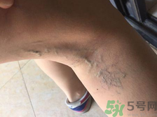 40歲女性小腿靜脈曲張?jiān)趺崔k？