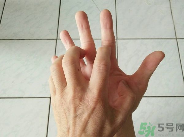 手上起水泡是什么原因？怎樣預(yù)防手上起水泡？