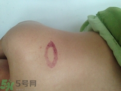 種草莓吻痕是什么意思？吻痕是怎么弄出來的？