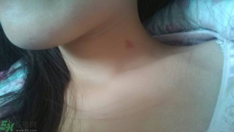 種草莓吻痕是什么意思？吻痕是怎么弄出來的？