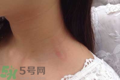 種草莓吻痕是什么意思？吻痕是怎么弄出來的？