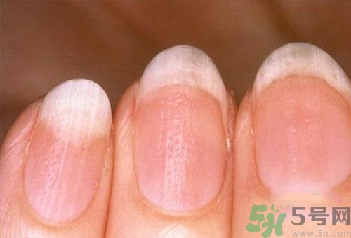 指甲發(fā)白是怎么回事？指甲發(fā)白代表什么？