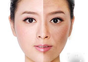 激光美白有用嗎？激光美白可以維持多久？