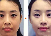 激光美白多少錢？激光美白價(jià)格