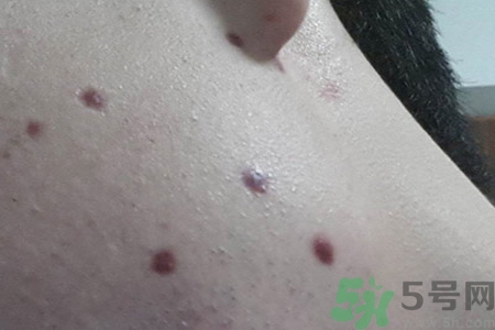 激光點(diǎn)痣后可以洗臉嗎？激光點(diǎn)痣后需要注意什么？