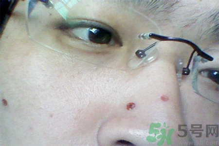 激光點痣后可以洗臉嗎？激光點痣后需要注意什么？