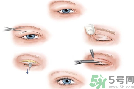 割雙眼皮分哪幾種？割雙眼皮需要多少錢？