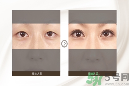 割雙眼皮分哪幾種？割雙眼皮需要多少錢？