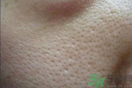 皮膚毛孔粗大原因有哪些？如何預(yù)防皮膚毛孔粗大？