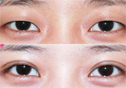 割雙眼皮分哪幾種？割雙眼皮需要多少錢？