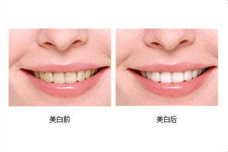 冷光美白牙齒可以保持多長時間？冷光美白牙齒有副作用嗎？
