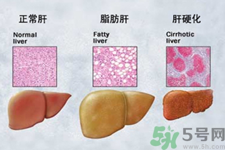 妊娠急性脂肪肝是什么？妊娠急性脂肪肝的治療方法？