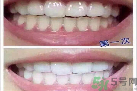 冷光美白牙齒的價(jià)格是多少？做冷光美白牙齒需要多少錢(qián)？