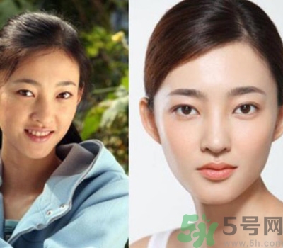 開眼角眼睛會變大嗎？開眼角眼睛能大多少？