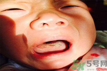 舌頭燙傷后該怎么辦呢？舌頭燙傷后應(yīng)該注意吃什么？?
