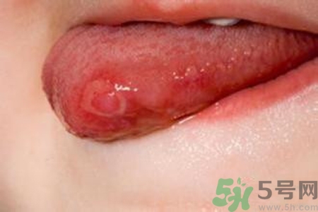 舌頭長泡怎么辦？舌頭長泡的原因？