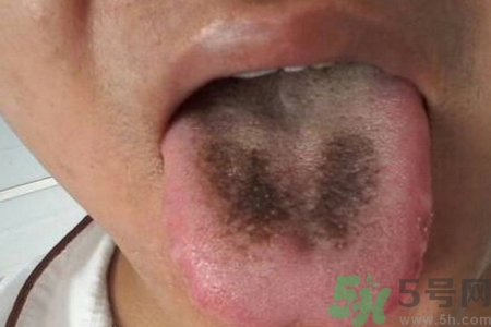 舌頭發(fā)黑怎么回事？舌頭發(fā)黑怎么辦？