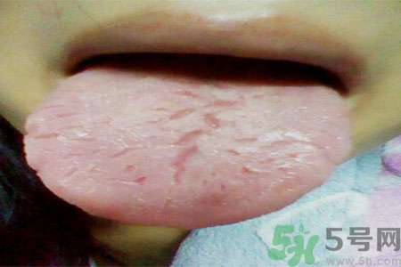 舌頭上有裂紋是怎么辦？舌頭上有裂紋是什么原因？