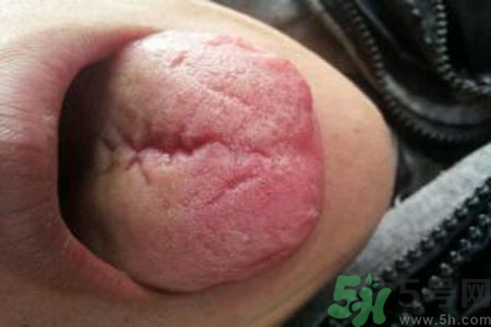舌頭上有裂紋是怎么辦？舌頭上有裂紋是什么原因？