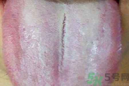 舌頭發(fā)白是什么原因？舌苔發(fā)白是怎么辦？