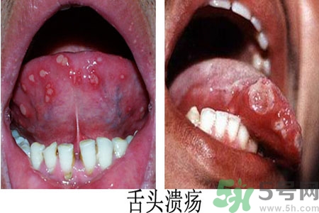 舌頭潰瘍?cè)趺崔k？舌頭潰瘍的原因？