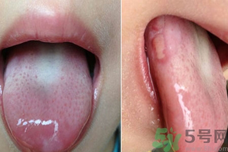 舌頭潰瘍?cè)趺崔k？舌頭潰瘍的原因？