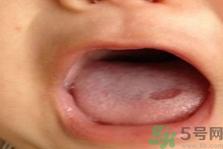 舌頭潰瘍怎么辦？舌頭潰瘍的原因？