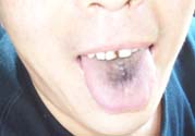 舌頭發(fā)黑怎么回事？舌頭發(fā)黑怎么辦？