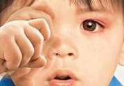 寶寶得了紅眼病怎么辦？寶寶得了紅眼病怎么治？