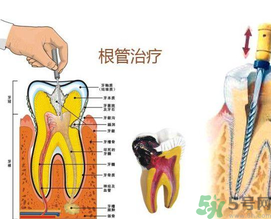 什么是根管治療？為什么牙齒疼要做根管治療？
