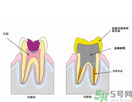 什么是根管治療？為什么牙齒疼要做根管治療？