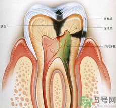 什么是根管治療？為什么牙齒疼要做根管治療？