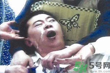 癲癇的典型癥狀有哪些？癲癇是什么？