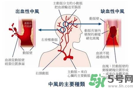 腦中風是什么？腦中風的癥狀？