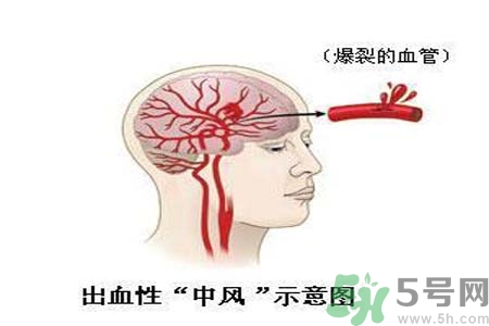 腦中風(fēng)的護(hù)理措施？腦中風(fēng)的飲食護(hù)理？