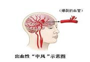 腦中風的發(fā)病因素？腦中風的并發(fā)癥有哪些 ？