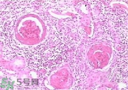慢性腎炎能治好嗎？慢性腎炎能活多久？