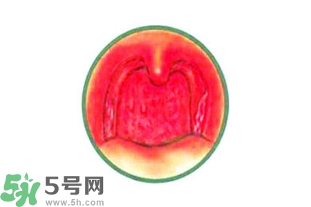 慢性咽炎的治療方法？慢性咽炎的藥物治療？