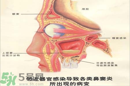 鼻竇炎是什么？鼻竇炎的癥狀有哪些？