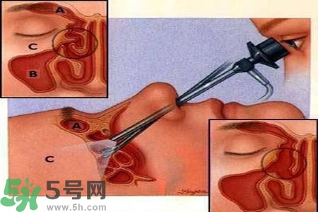 鼻竇炎的高發(fā)人群？如何預(yù)防鼻竇炎？