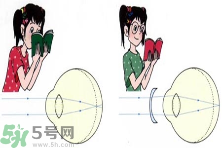 近視眼的發(fā)病因素？近視眼的并發(fā)癥有哪些？