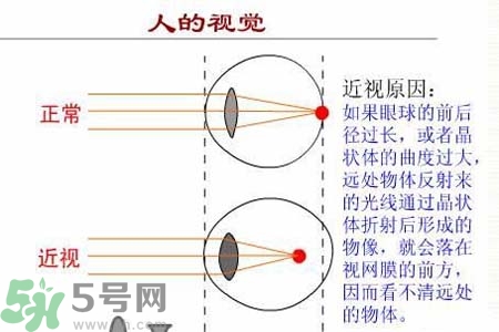 近視眼高發(fā)人群？如何預防近視眼？