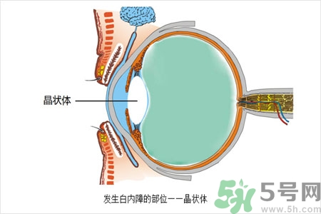 白內(nèi)障的護(hù)理措施是什么？白內(nèi)障的飲食護(hù)理有哪些？