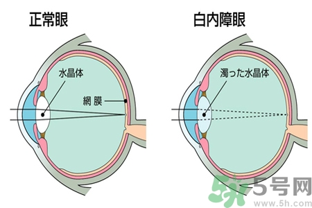 白內(nèi)障治療方法是什么？白內(nèi)障可以用什么藥物治療？